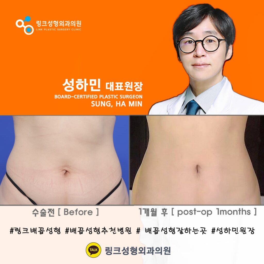 배꼽성형_배꼽수술_배꼽성형방법_링크성형외과_성하민원장_72