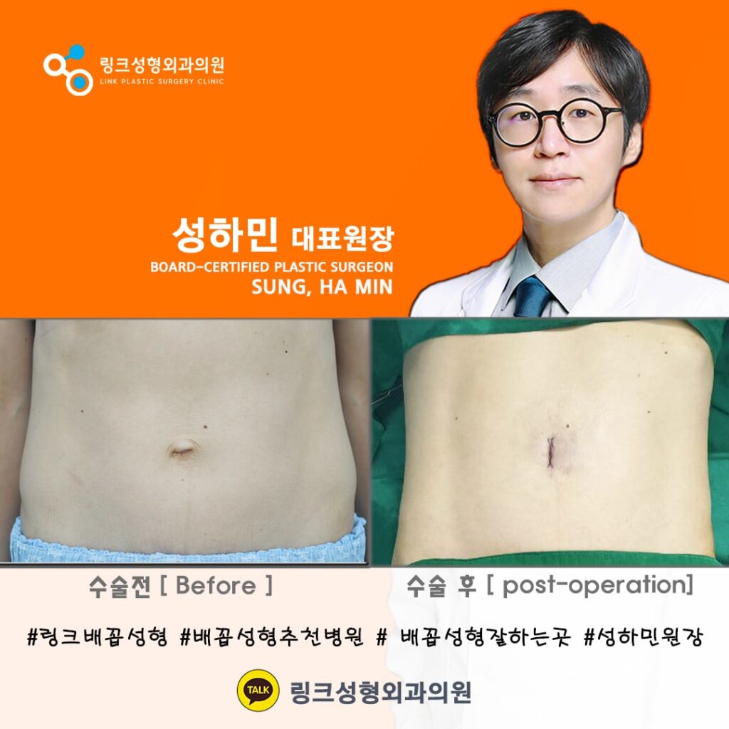배꼽성형_배꼽수술_배꼽성형방법_링크성형외과_성하민원장_77