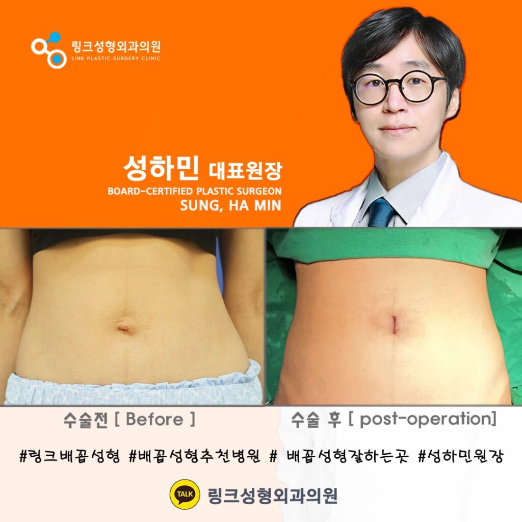 배꼽성형_배꼽수술_배꼽성형방법_링크성형외과_성하민원장_75