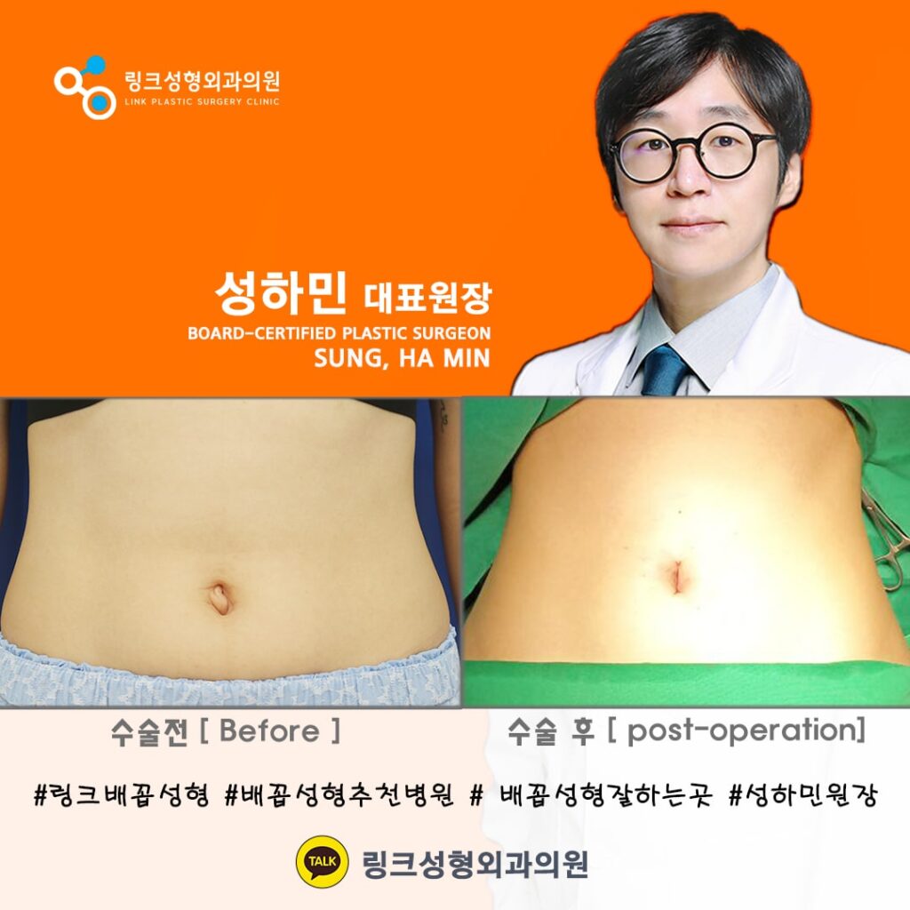 배꼽성형_배꼽수술_배꼽성형방법_링크성형외과_성하민원장_70