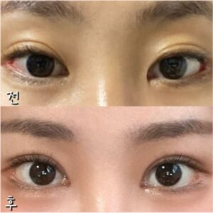 눈재수술_링크성형외과_정민수_정민수원장